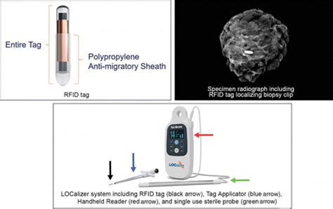 rfid tag event|rfid tagging in breast surgery.